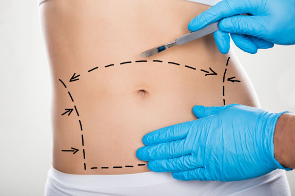 Abdominoplastik Mainz